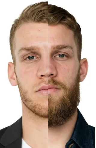 Baardtransplantatie resultaat
