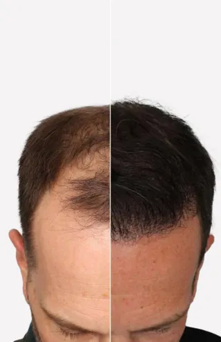FUE haartransplantatie resultaat